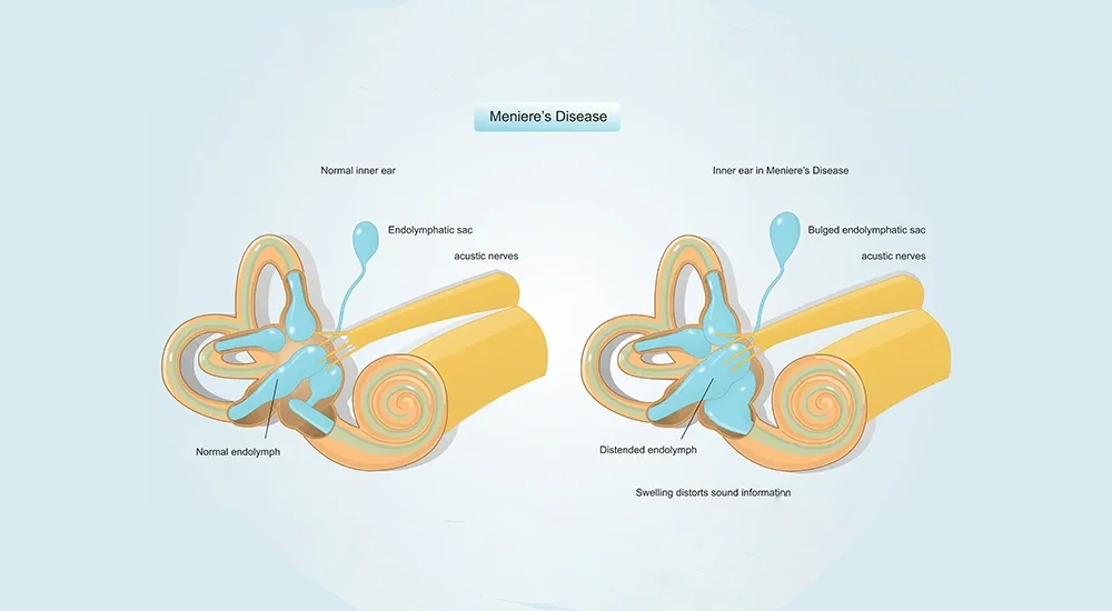 Meniere’s Disease – Symptoms, Causes and Treatment